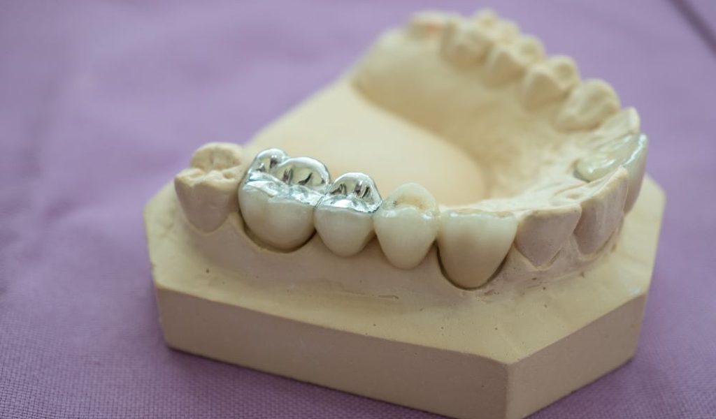 dental fillings model