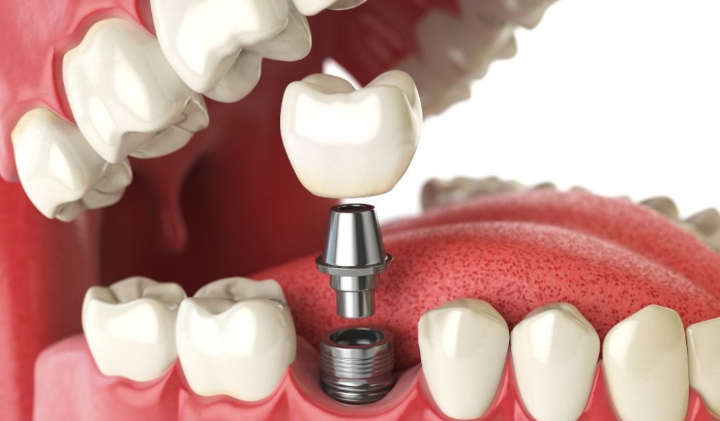 model of a dental implant