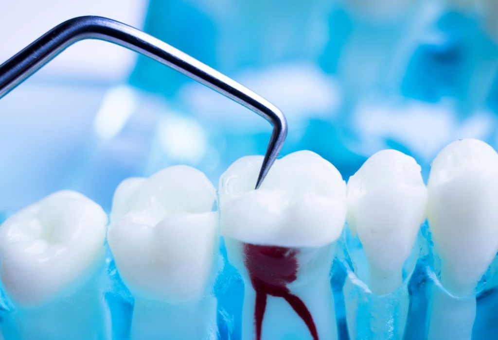 root canal treatment