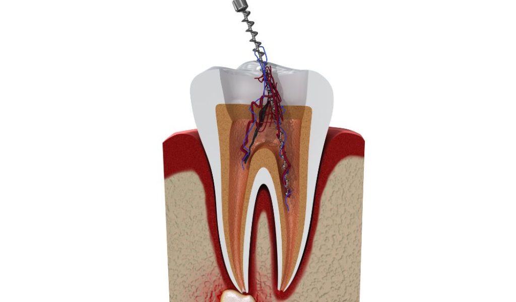 root canal therapy